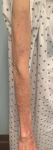 Allergic Contact Dermatitis Case-13 Before