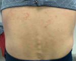Allergic Contact Dermatitis Case-15 Before