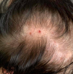 Eczema/ Atopic Dermatitis Case-27 Before