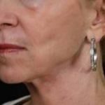 Ultherapy<sup>®</sup> Before and After Case 2 After
