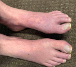 Allergic Contact Dermatitis Case-18 Before