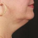 Ultherapy<sup>®</sup> Before and After Case 3 Before