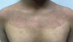 Atopic Dermatitis (6 Month Dupixent) Case-29 Before