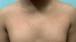 Atopic Dermatitis (6 Month Dupixent) Case-29 After