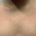 Atopic Dermatitis (6 Month Dupixent) Case-29 After