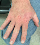 Atopic Dermatitis (6 Month Dupixent) Case-30 Before