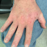 Atopic Dermatitis (6 Month Dupixent) Case-30 Before