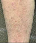 Atopic Dermatitis (2 Month Celebrex) Case-31 Before