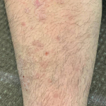 Atopic Dermatitis (2 Month Celebrex) Case-31 Before