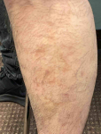 Atopic Dermatitis (2 Month Celebrex) Case-31 After
