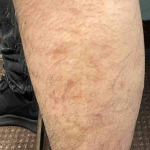 Atopic Dermatitis (2 Month Celebrex) Case-31 After