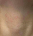 Atopic Dermatitis (6 Month Dupixent) Case-33 After