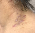 Atopic Dermatitis (6 Month Dupixant) Case-34 Before