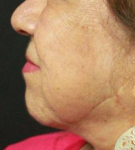 Ultherapy<sup>®</sup> Before and After Case 4 Before