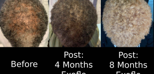 Hair Restoration Before and After Case 5 