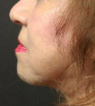 Ultherapy<sup>®</sup> Before and After Case 4 After