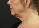 Ultherapy<sup>®</sup> Before and After Case 5 Before