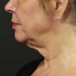 Ultherapy<sup>®</sup> Before and After Case 5 Before