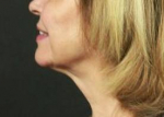 Ultherapy<sup>®</sup> Before and After Case 5 After