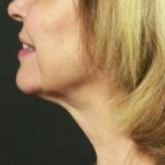 Ultherapy<sup>®</sup> Before and After Case 5 After