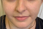 Acne Before and After Case 20 After