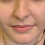 Acne Before and After Case 20 After