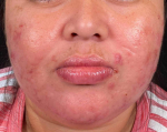 Acne Before and After Case-22 Before