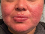 Acne Before and After Case-22 After