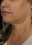 Ultherapy<sup>®</sup> Before and After Case 6 Before