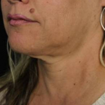 Ultherapy<sup>®</sup> Before and After Case 6 Before