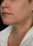 Ultherapy<sup>®</sup> Before and After Case 6 After