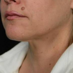 Ultherapy<sup>®</sup> Before and After Case 6 After