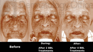 Rosacea and BBL Case-14 