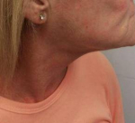Ultherapy<sup>®</sup> Before and After Case 7 After