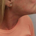 Ultherapy<sup>®</sup> Before and After Case 7 After