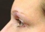 Ultherapy<sup>®</sup> Before and After Case 8 Before