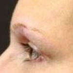 Ultherapy<sup>®</sup> Before and After Case 8 Before