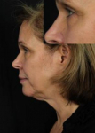 Ultherapy<sup>®</sup> Before and After Case 9 Before