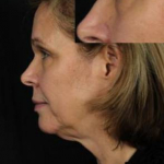 Ultherapy<sup>®</sup> Before and After Case 9 Before