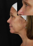 Ultherapy<sup>®</sup> Before and After Case 9 After