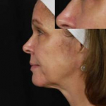 Ultherapy<sup>®</sup> Before and After Case 9 After