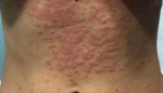 Psoriasis Before and After Case 1 Before
