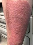 Psoriasis Before and After Case 2 Before