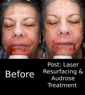 Laser Resurfacing (1 Treatment) Case-1 