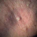 Skin Cancer (17 Radiation Treatment) Case-38 Before