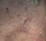 Skin Cancer (17 Radiation Treatment) Case-38 After