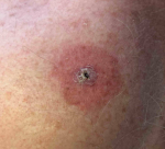 Skin Cancer (17 Radiation Treatment) Case-39 Before