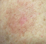 Skin Cancer (17 Radiation Treatment) Case-39 After