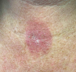 Skin Cancer (14 Radiation Treatment) Case-40 Before