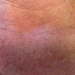 Skin Cancer (14 Radiation Treatment) Case-40 After